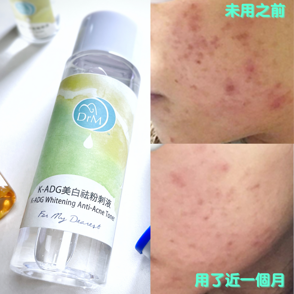 K-ADG 美白祛粉刺液Whitening Anti-acne Toner
